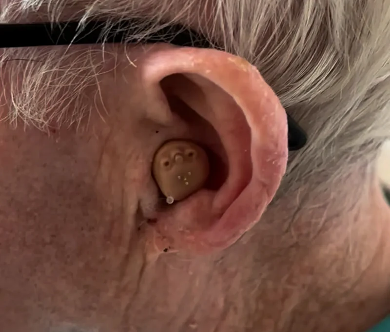 Close-up of an ear wearing a hearing aid device, showing detailed fit and design for hearing improvement.