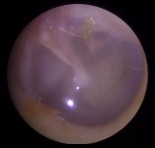 Close-up image of an eardrum viewed through an otoscope, showing ear canal detail and drum texture.