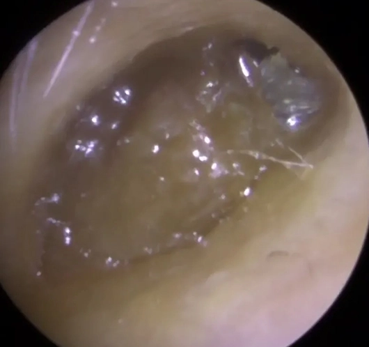 Close-up of ear canal showing earwax buildup under magnification.