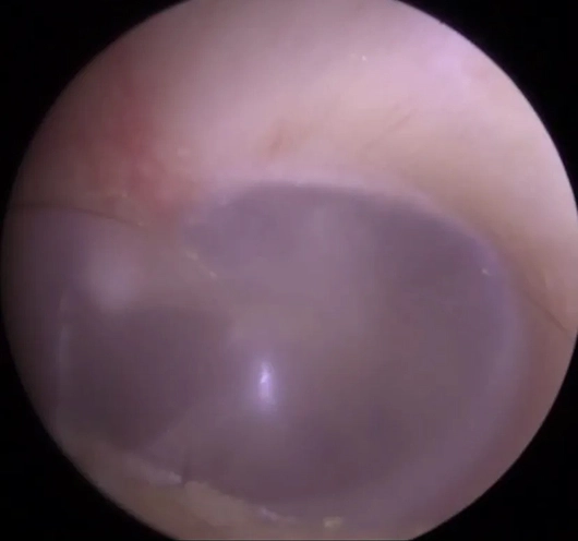 Close-up view of human eardrum, showcasing ear anatomy and structure in detail.
